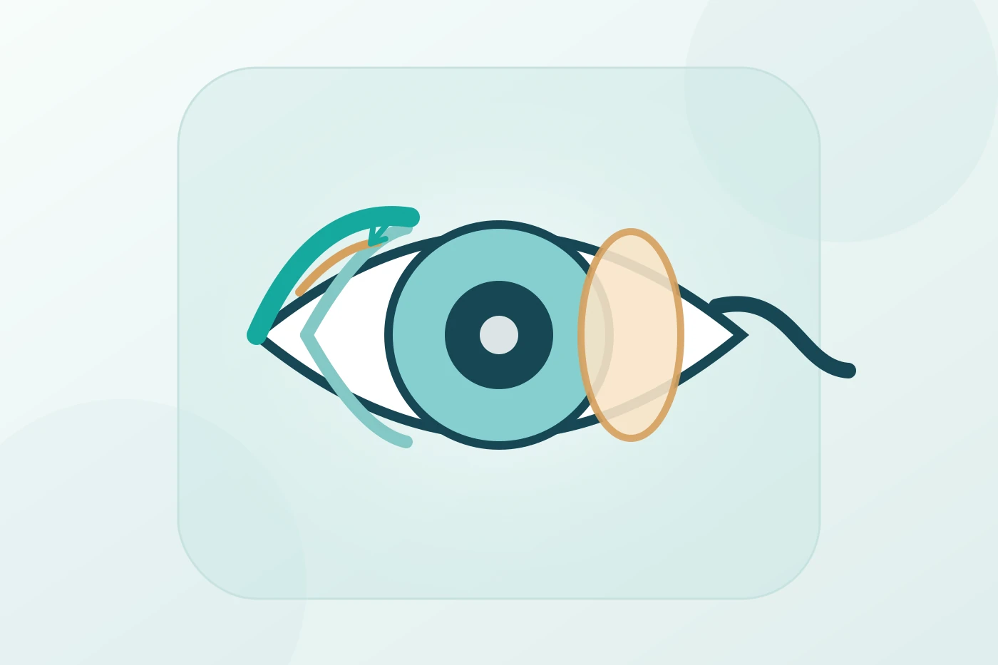 Patient comparing LASIK and SMILE laser eye surgery with an ophthalmologist using corneal imaging, diagnostic scans and eye models during a detailed consultation.